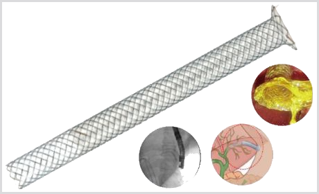 Stent Biliar GIOBOR