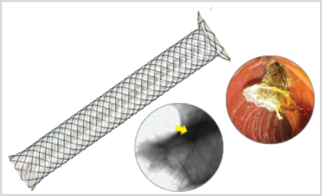 Stent Biliar S Flare Anti-migração