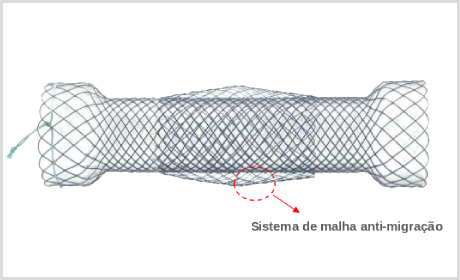 Stent Esofágico DOUBLE Anti-migração