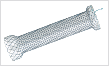 Stent Esofágico CERVICAL