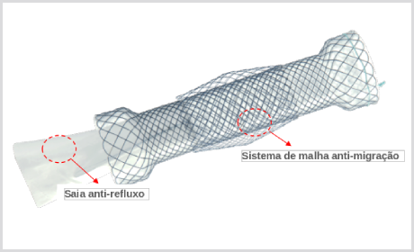 Stent Esofágico DOUBLE anti-refluxo