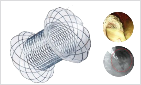 Stent NAGI