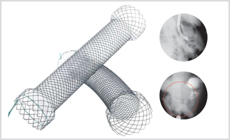 Stent Pilórico Duodenal S