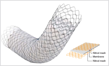 Stent Pilórico Duodenal COMVI