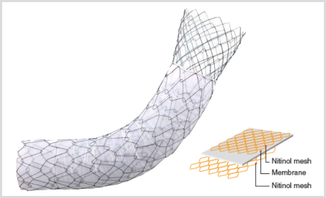 Stent Pilórico Duodenal COMVI Flare