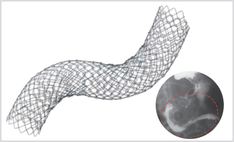 Stent Pilórico Duodenal D