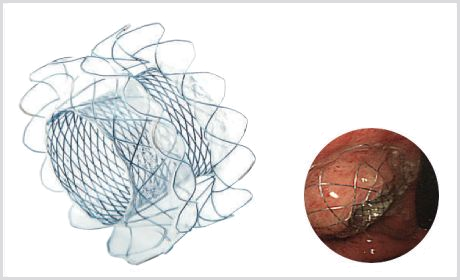 Stent HOT SPAXUS